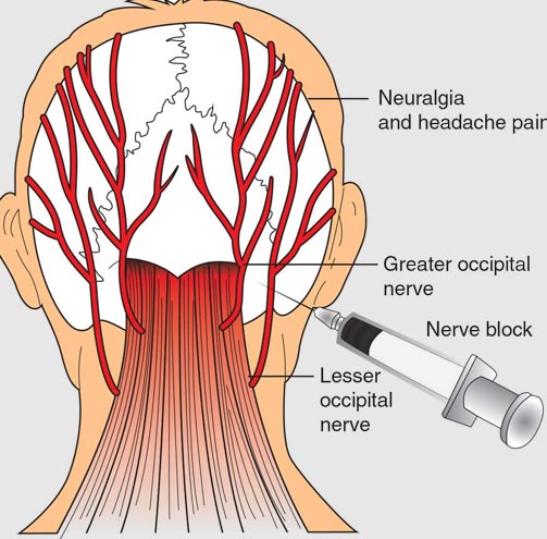 occipital-nerve-block1 | Interventional Pain & Spine Centre