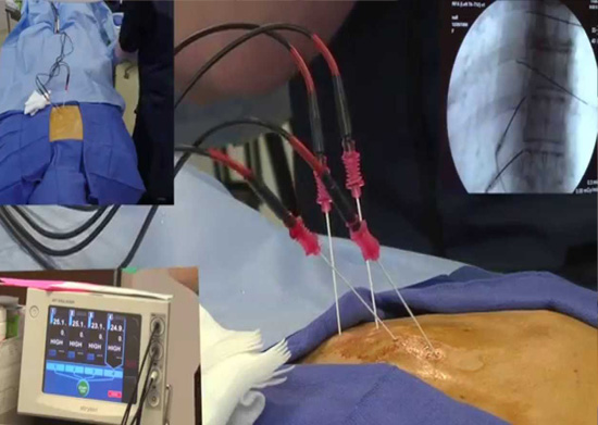 radiofrequency_ablation4 | Interventional Pain & Spine Centre