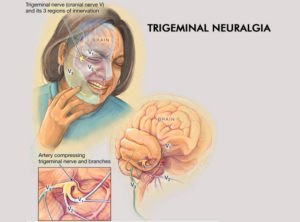 Raymond recommends best of Facial nerve pain from Adult Pictures Penetration xxx trailers free