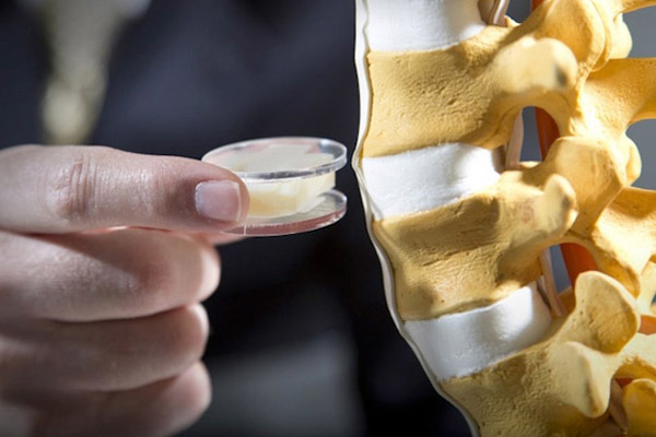 Slipped Disc Specialist in India