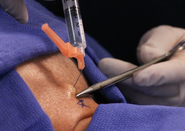 Epidural Injection | Back Pain Injection Treatment | New Delhi | Delhi