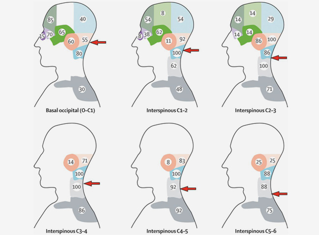 Headache Migraine Interventional Pain Spine Centre