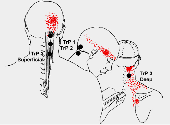 Headache Migraine Interventional Pain Spine Centre
