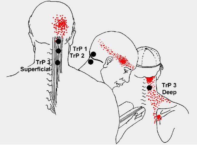 Headache Migraine Interventional Pain Spine Centre Headache Migraine Interventional Pain Spine Centre