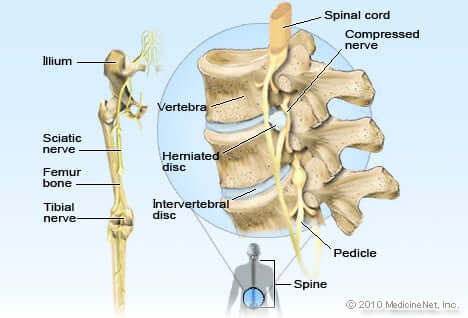 what is slipped disc