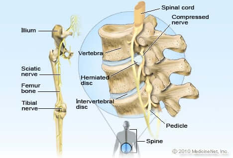 what is slipped disc