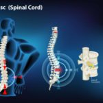 SLIPPED DISC: CAUSES, SYMPTOMS AND TREATMENT